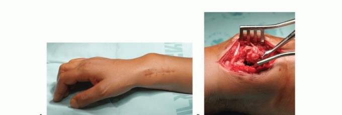 صورة طبية: تجنب الجراحة الكبرى: علاج أورام العظام بالنيتروجين السائل بتقنية الصب المباشر