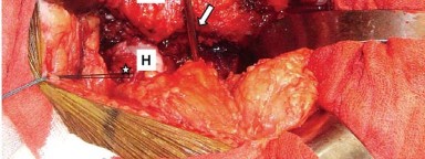 Illustration 5 for Mastering Soft Tissue Balancing for Optimal THR Outcomes