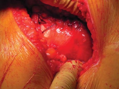 صورة طبية: تقنية الجذع القصير لاستبدال مفصل الورك الكلي: نهج الأستاذ الدكتور محمد هطيف لتدخل جراحي أقل ونتائج أفضل