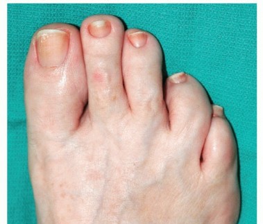 Metatarsal Lengthening: End Pain After Hallux Valgus Surgery