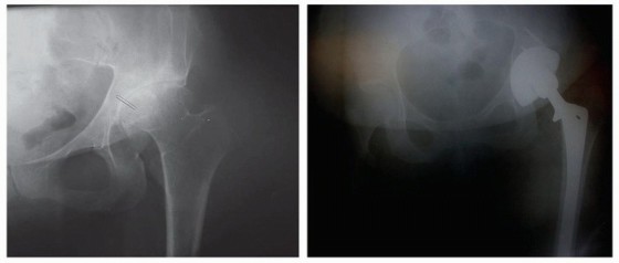 صورة توضيحية لـ إعادة بناء مفصل الورك المعقد لخلع الورك التنموي (DDH) باستخدام ترقيع رأس الفخذ الذاتي في صنعاء