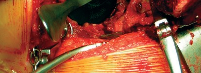 صورة طبية: طول عمر مكون الحُق الأسمنتي في مفصل الورك: مفتاح الاستقرار والديمومة مع الأستاذ الدكتور محمد هطيف في صنعاء