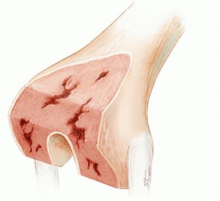 Illustration of revision femoral component - Dr. Mohammed Hutaif