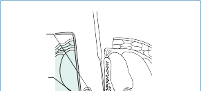 Illustration 70 for Mastering Thoracolumbar Surgery: Full Operative Planning