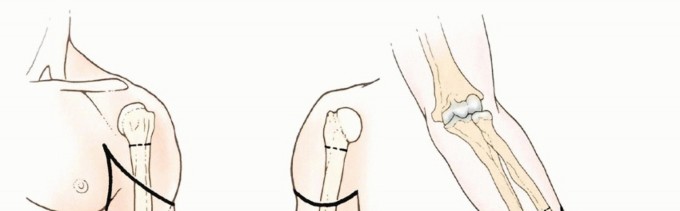 Above-Elbow and Below-Elbow Amputations