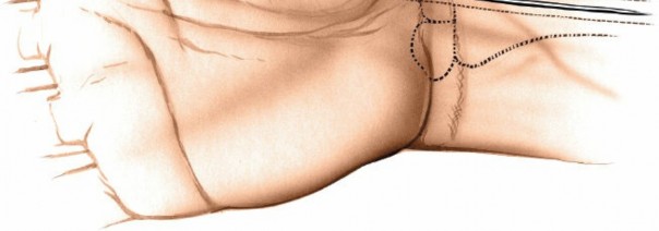 Illustration 52 for Essential Surgical Approaches: Uncover Every Aspect of the Wrist