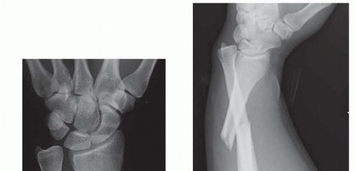 Galeazzi DRUJ Stabilization: Unlocking Stability with Smooth Stainless Steel