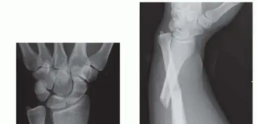 صورة توضيحية لـ كسر غالييزي وخلع مفصل الرسغ: دليل شامل للمرضى من الدكتور محمد هطيف