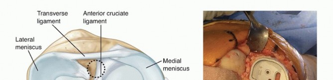 Illustration 17 for Achieve Lasting Pain Relief with Cemented Total Knee Arthroplasty