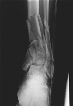 Illustration 6 for Ace Your FRCS: Key Questions in Trauma & Orthopaedics