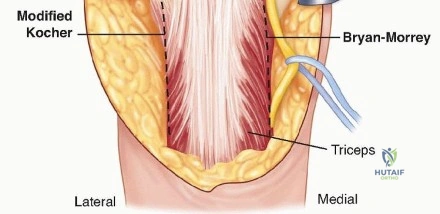 Illustration 8 for Optimizing ORIF for Distal Humerus: Prevent Class II HO