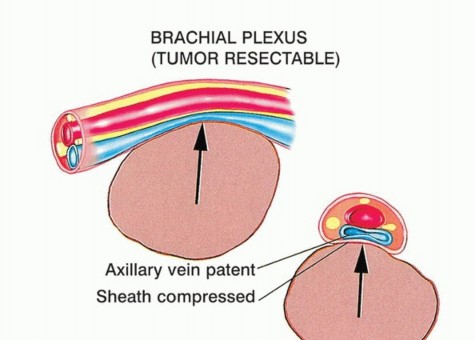 Resectable tumor