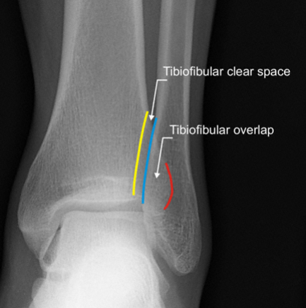 Ankle Fracture: Your Guide to a Fractured Ankle Injury