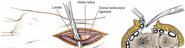 Illustration 24 for Dorsal Wrist Approach: Expert Access to the Column of the Distal Radius
