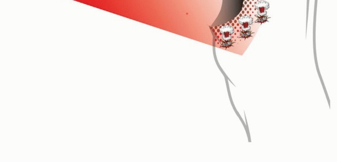 صورة توضيحية لـ الاستئصال الموجه لأورام الجهاز العضلي الهيكلي: نهج أكثر أمانًا وفعالية مع الأستاذ الدكتور محمد هطيف