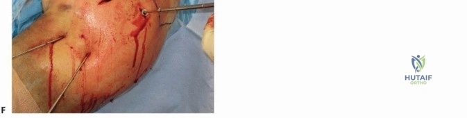 متلازمة الحيز الإجهادية المزمنة الدليل الشامل للأعراض والعلاج