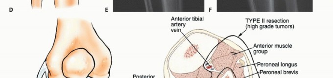 صورة توضيحية لـ استئصال أورام الشظية: دليل شامل للعلاج الحديث والحفاظ على الأطراف مع الأستاذ الدكتور محمد هطيف