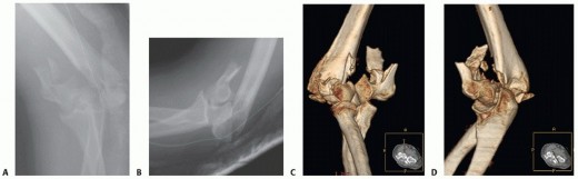Illustration of supracondylar and intercondylar - Dr. Mohammed Hutaif