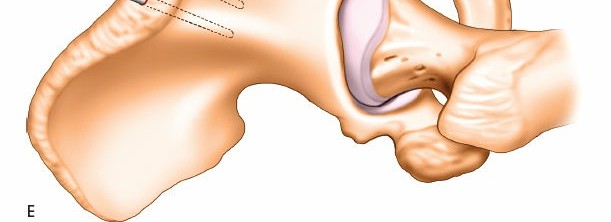 Illustration 21 for Expert Guide: Ulna and Wrist External Fixation Pin Placement
