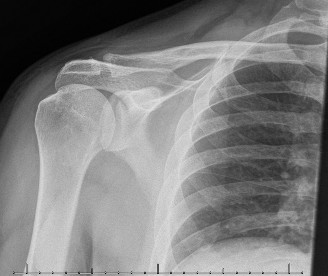 Illustration 40 for Right Shoulder Pain? Avoid This Common X-ray Mistake.