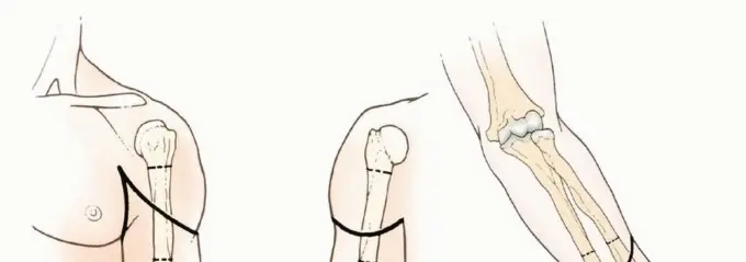 صورة توضيحية لـ بتر الذراع فوق وتحت الكوع: متى ولماذا يصبح ضرورة طبية؟ دليل شامل من الأستاذ الدكتور محمد هطيف