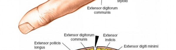 Illustration 6 for Dorsal Wrist Approach: Expert Access to the Column of the Distal Radius
