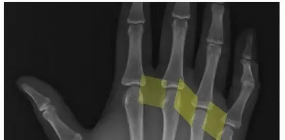 كسور عظام اليد (المشط): دليل المريض الشامل للتشخيص والعلاج والتعافي في اليمن والخليج