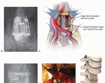 Illustration 21 for Anterior Lumbar Interbody: Fusion, Disc Replacement & Pain Relief