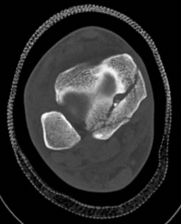 Illustration 6 for Partial Articular Fractureplate Fixation: Restore Anatomy