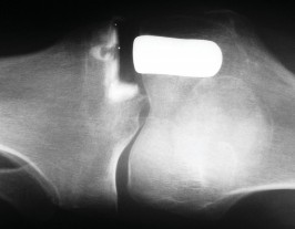 Illustration 77 for Knee Arthroplasty: Avoiding Pitfalls & Benefiting from UKA