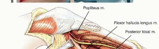 صورة توضيحية لـ معالجة الأورام المعقدة في قصبة الساق القريبة حلول الحفاظ على الأطراف