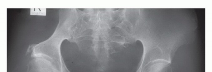 توضيح طبي: جراحة نقائل الحوض: حل شامل لآلام العظام واستعادة الحركة مع الأستاذ الدكتور محمد هطيف