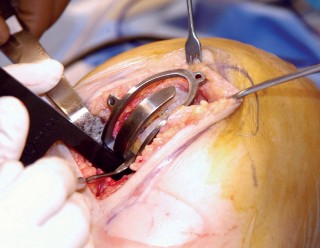 Illustration 66 for Unicompartmental Knee Arthroplasty: Master decisions with this b c figure guide.
