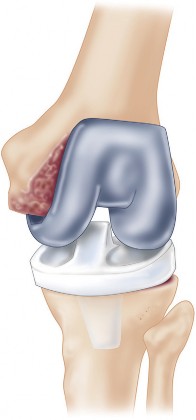 Illustration of structural allografting figure - Dr. Mohammed Hutaif