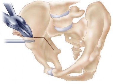 Illustration 31 for Bernese PAO: Unlocking the Procedure with Level V Evidence Insights