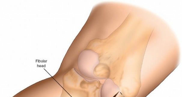 Figure 7: Close-up of leg positioning with knee flexed approximately 20 degrees by a bolster under the ankle.