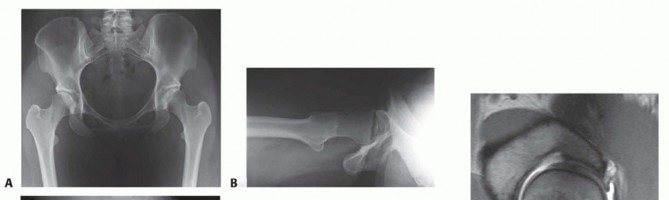 Proximal Femoral Osteotomy: When This Hip-Saving Surgery Is Performed