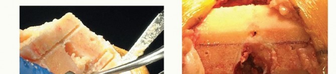 Illustration 29 for Achieve Lasting Pain Relief with Cemented Total Knee Arthroplasty