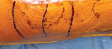 Illustration 8 for Minimize Pain, Maximize Recovery: TKA with Parapatellar