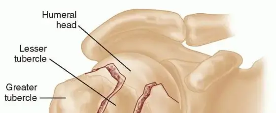 صورة توضيحية لـ كسور عظم العضد القريب: دليل شامل للعلاج والتعافي مع الأستاذ الدكتور محمد هطيف