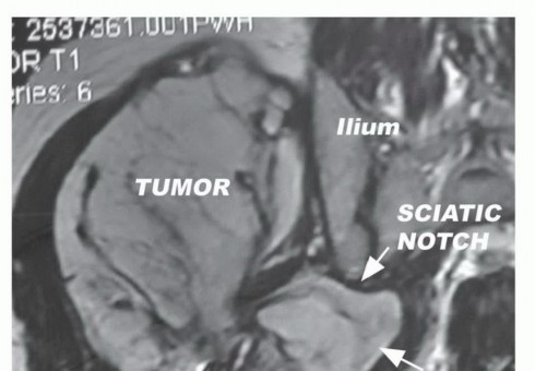 Beyond Hemipelvectomy: Preservation of the Sciatic in Buttock Surgery
