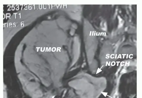 صورة توضيحية لـ ساركوما الأرداف: الحفاظ على العصب الوركي بدلاً من استئصال نصف الحوض مع الأستاذ الدكتور محمد هطيف