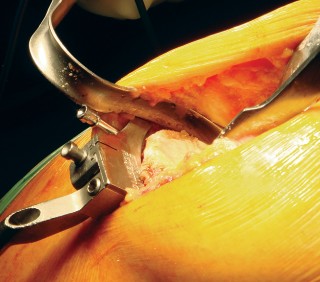 Illustration 16 for Cemented TKA Figure: Your Visual Guide to Surgical Success