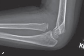 Illustration 3 for 5 Pediatric Fracture Cases: Mastering Reduction and Casting