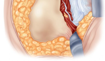 Illustration 5 for Unlock the Figure Posterior Approach to the Hip