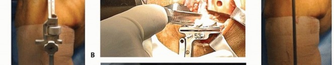 Illustration 12 for Unicondylar Knee Arthroplasty: Is This Your Solution to Knee Pain?