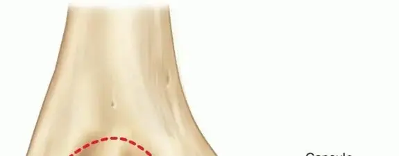 كسر اللقيمة الإنسية للمرفق: دليل شامل للعلاج والتعافي بفضل خبراء اليمن