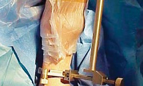 Illustration 32 for Unicompartmental Knee Arthroplasty: Master decisions with this b c figure guide.