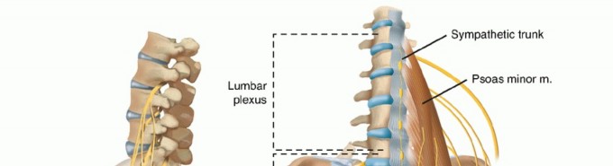 Illustration of lateral interbody fusion - Dr. Mohammed Hutaif