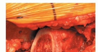 Illustration 12 for Uncemented THA: Critical Soft Tissue Tension for Joint Stability
